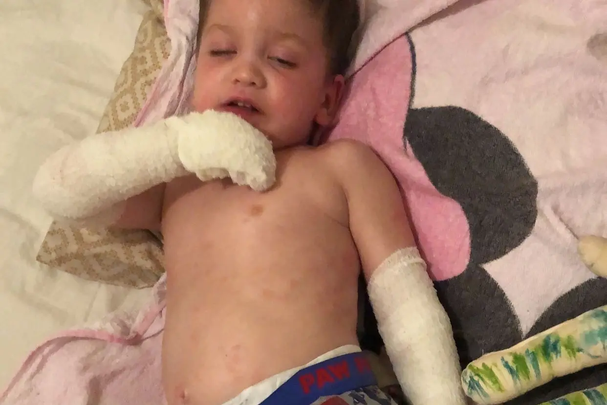 <p>Hosie Tanner wet wrapped for his severe eczema.</p>\\n